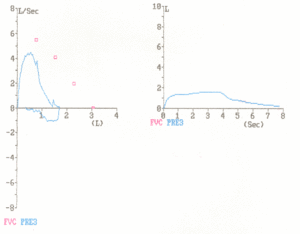 Flow volume loop - restrictive.gif