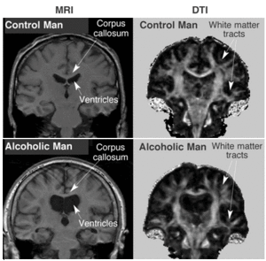 Mri alcohol.gif