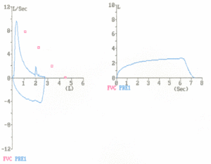 Flow volume loop - obstruction.gif