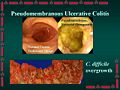 Pseudomembranous enterocolitis, a CDAD