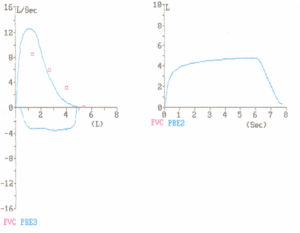 Flow volume loop - normal.gif